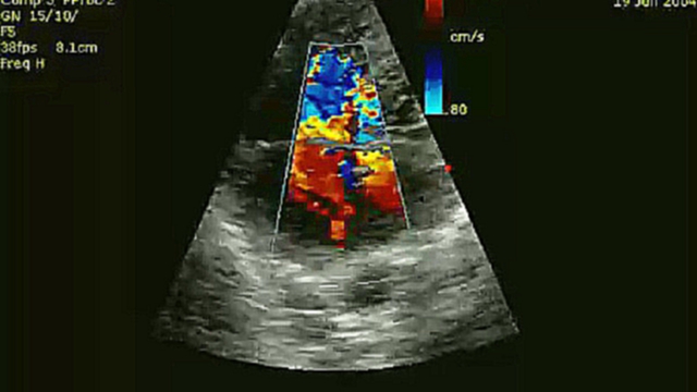 Подборка Открытое овальное окно при ультразвуковом исследовании  сердца
